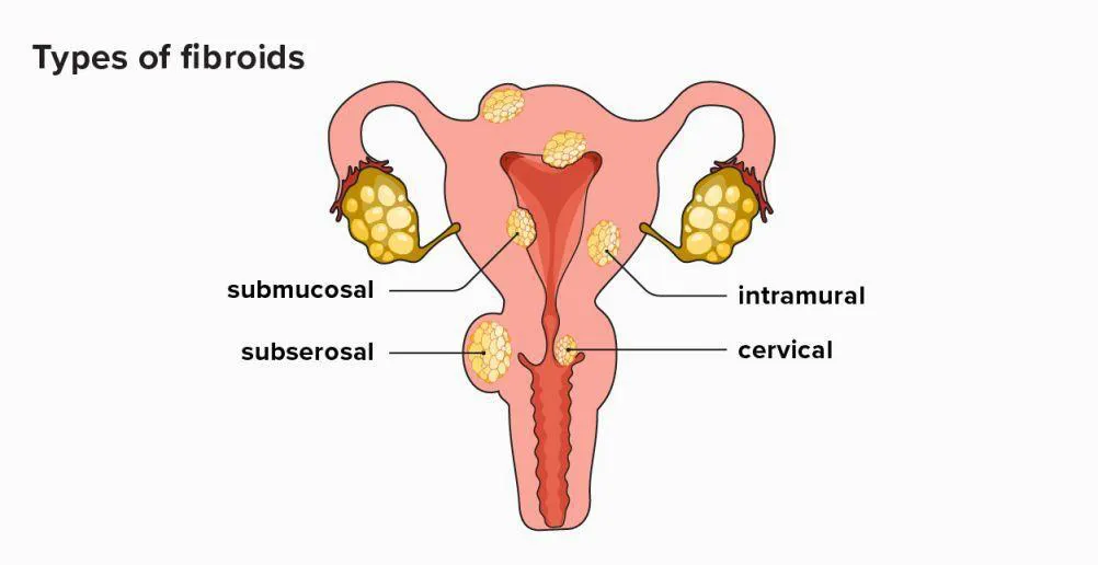 Uterine Fibroids Treatment Without Surgery, Symptoms & Causess