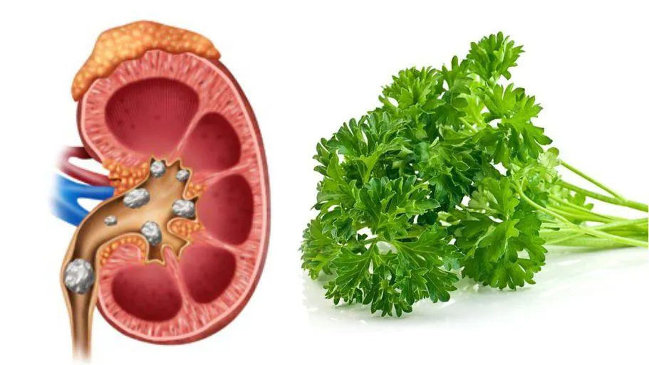 Kidney Stones: Natural Treatments