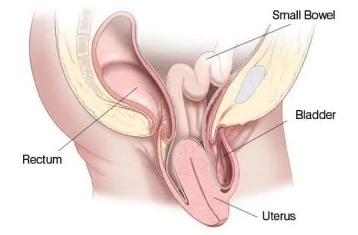 Master The Art of Vaginal Prolapse Treatment With These 6 Tips